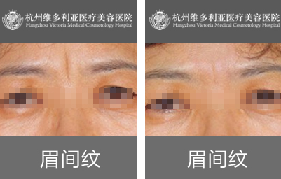 眉间纹祛除前后对比案例