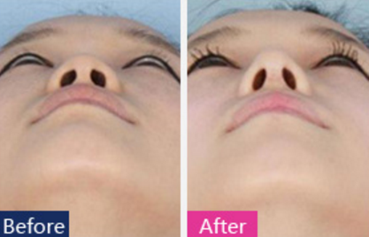 鼻小柱延长手术前后对比