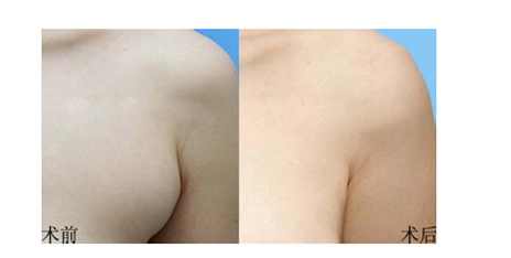 副乳切除手术前后对比图