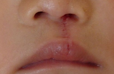 隐形唇腭裂修复手术