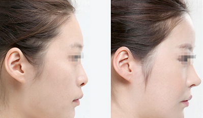 自体软骨隆鼻和假体隆鼻对比的优势