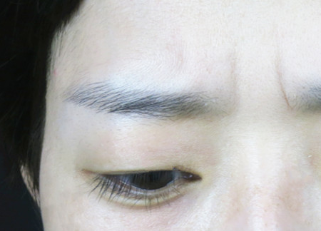 注射玻尿酸祛眉间纹效果好吗