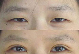 杭州韩式三点式双眼皮手术
