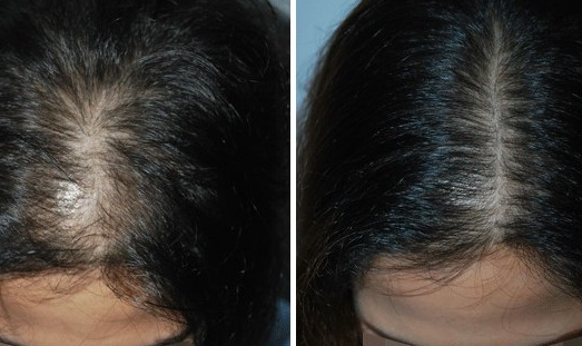 头发加密植发会伤害头皮吗
