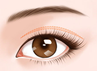 双眼皮修复方法有哪几种