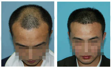 丁先生在杭州做了植发手术