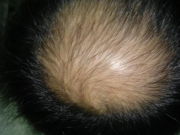 脂溢性脱发可以做植发手术吗