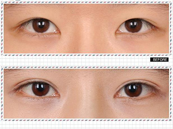 韩式三点双眼皮就是埋线双眼皮吗
