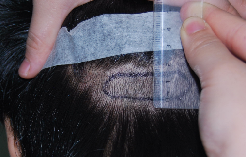 疤痕性脱发如何治疗？