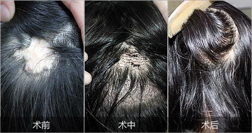疤痕种植头发的过程