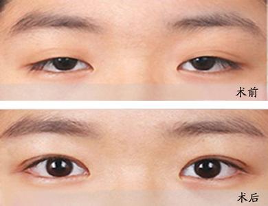 韩式双眼皮手术价格贵吗