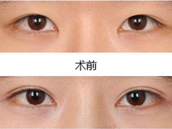 做韩式双眼皮手术
